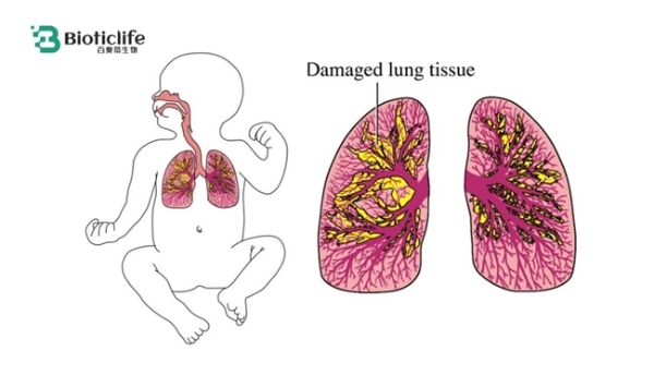 迈入临床验证关键阶段：百奥蒂披露脐带间充质干细胞用于新生儿肺疾病研究最新进展 
