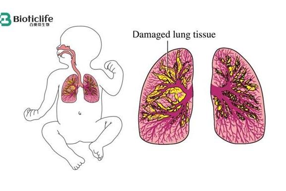 迈入临床验证关键阶段：百奥蒂披露脐带间充质干细胞用于新生儿肺疾病研究最新进展 