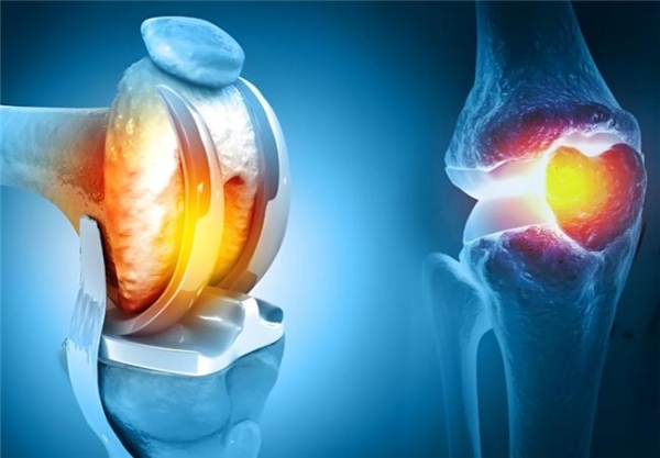 骨关节炎如何应对？先搞清楚硫酸和盐酸氨基葡萄糖胶囊有什么区别 