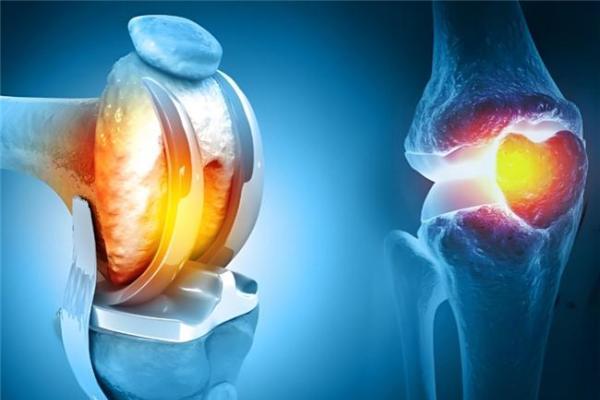 骨关节炎如何应对？先搞清楚硫酸和盐酸氨基葡萄糖胶囊有什么区别 