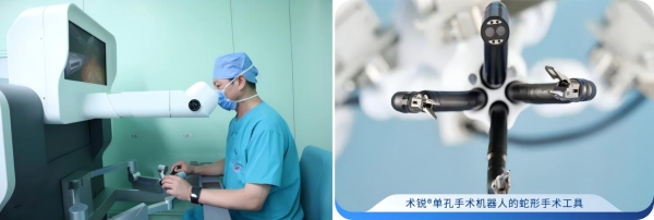 北京大学首钢医院冷建军团队应用术锐单孔蛇形臂机器人完成20多例高难度肝胆胰手术 