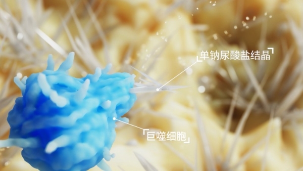 半年一针，长效抗炎为先：47岁厂长终结“越减越痛”，打赢膝盖保卫战 