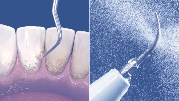 2026电动牙刷榜单推荐：锐舞气泡电动牙刷“微洗牙”功能实测 