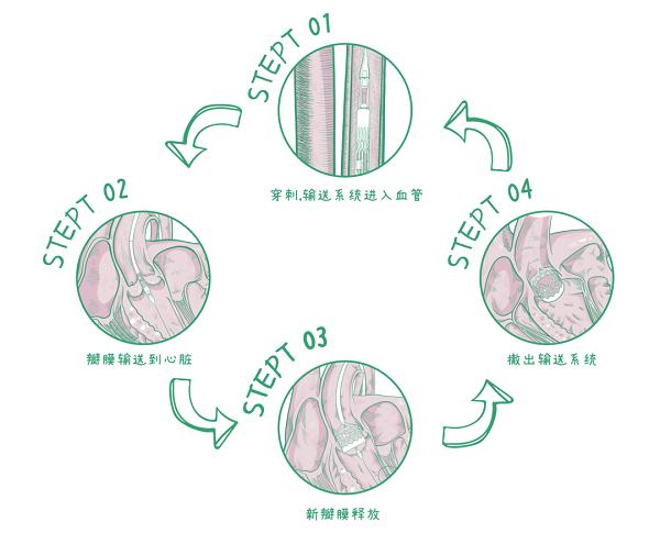 经导管主动脉瓣置换术（TAVR）手术全揭秘：从穿刺到瓣膜释放 