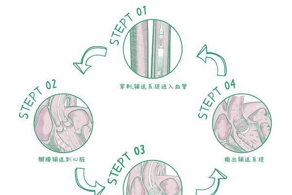 经导管主动脉瓣置换术（TAVR）手术全揭秘：从穿刺到瓣膜释放 