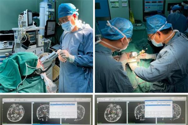 瑞神安可感知脑深部电刺激系统在青岛市市立医院成功完成植入 