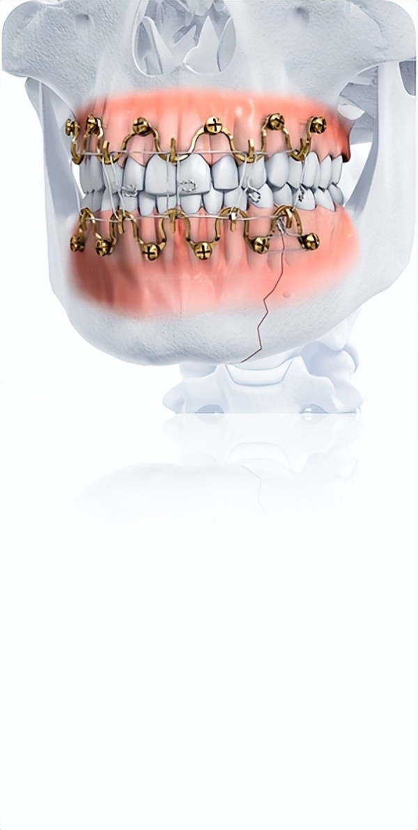 DePuy Synthes MatrixWAVE颌间固定系统中国首批20家医院成功开台 