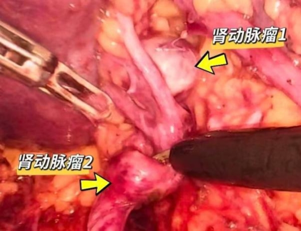 全球首例！江苏省肿瘤医院完成蛇形臂单孔机器人双肾动脉瘤一期切除 + 肾动脉成型术