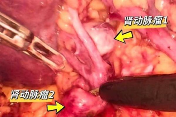 全球首例！江苏省肿瘤医院完成蛇形臂单孔机器人双肾动脉瘤一期切除 + 肾动脉成型术