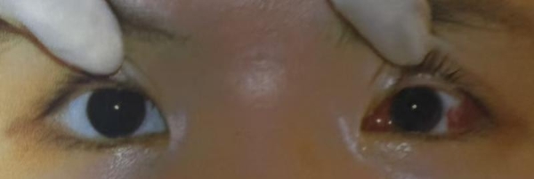 斜视手术点亮少年自信，广州爱尔眼科徐永峰：暑假治斜视正当时 