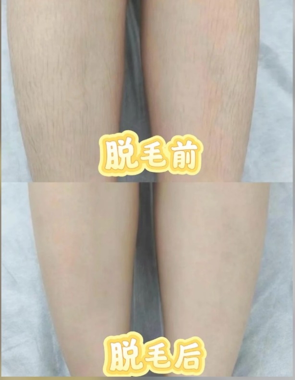 懒人脱毛仪哪款值得入手？2026热门测评揭晓：ycyn自动连闪，省时不痛性价比拉满 