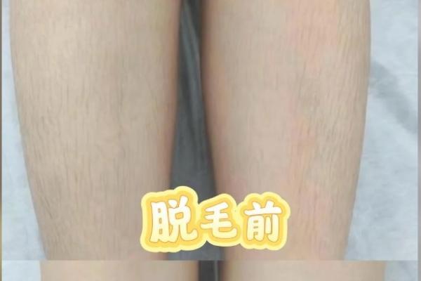 懒人脱毛仪哪款值得入手？2026热门测评揭晓：ycyn自动连闪，省时不痛性价比拉满 