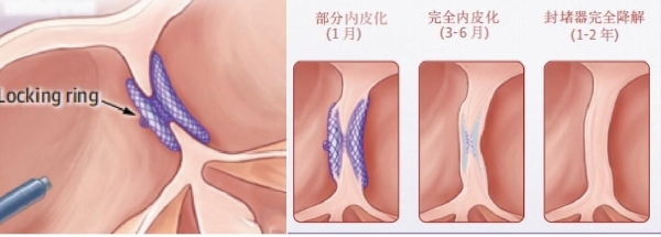 先心家长背后的焦虑，可降解封堵器如何化解？ 