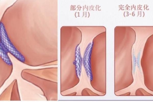 先心家长背后的焦虑，可降解封堵器如何化解？ 