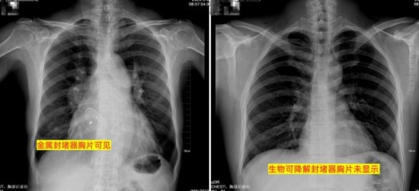 卵圆孔未闭封堵器怎么选？别只看新旧，“合适”比什么都重要 