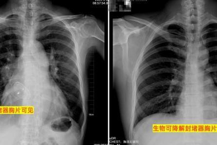 卵圆孔未闭封堵器怎么选？别只看新旧，“合适”比什么都重要 