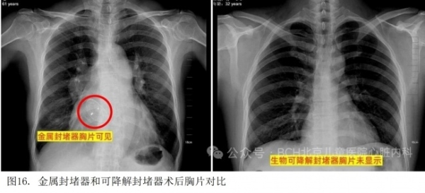 即刻非劣，中远期减负：可降解封堵器对比金属封堵器的临床证据解析 