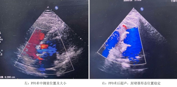 高原“心”突破：青海区域医疗中心成功完成首两例MemoSorb可降解封堵术 