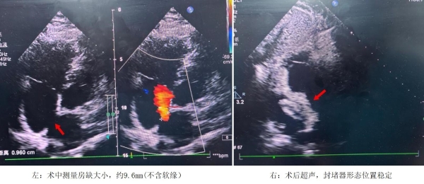 高原“心”突破：青海区域医疗中心成功完成首两例MemoSorb可降解封堵术 