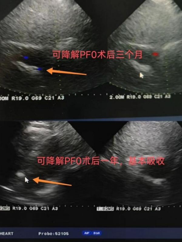 老年患者PFO介入治疗，为何更需关注“可降解”？ 