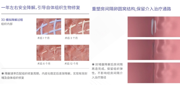 老年患者PFO介入治疗，为何更需关注“可降解”？ 