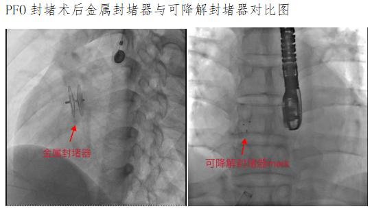 老年患者PFO介入治疗，为何更需关注“可降解”？ 