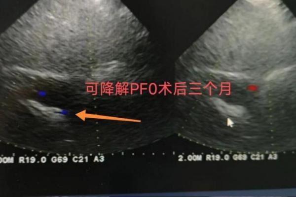 老年患者PFO介入治疗，为何更需关注“可降解”？ 