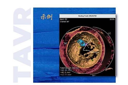 球扩瓣Borderline瓣环如何选型？两档之间，选小还是选大？ 