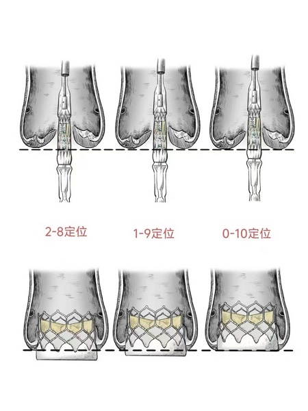 告别盲目选瓣！一文理清TAVR球扩瓣锚定区考量与Oversizing建议