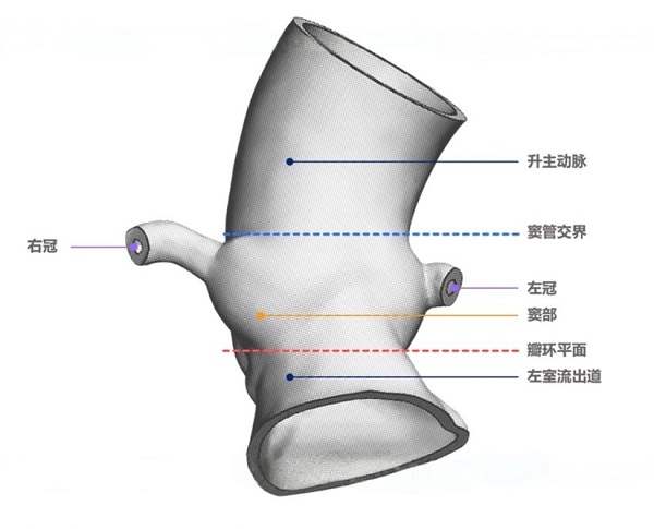 告别盲目选瓣！一文理清TAVR球扩瓣锚定区考量与Oversizing建议