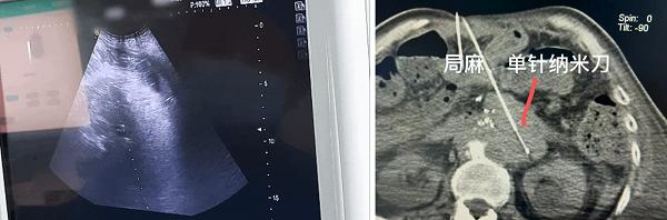 广州复大突破性开展局麻下胰腺癌纳米刀单针消融术 