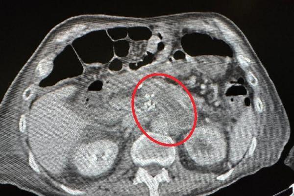 临床实践丨81岁复发胰腺癌，国产维纳刀成功消融！ 