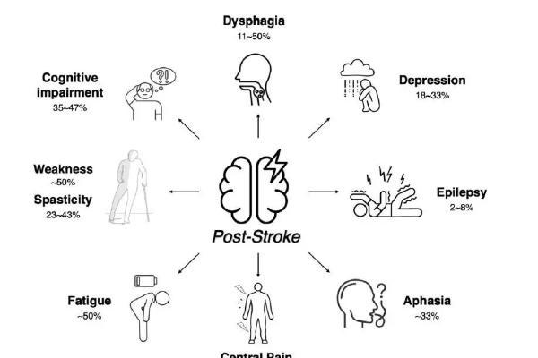 30 项研究、1217 例患者循证：干细胞与脑卒中康复的新探索