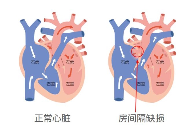 一次介入破解“巨大房缺+金属过敏”双重难题！金坛一院首例可降解封堵术为患者无痕“补”心 