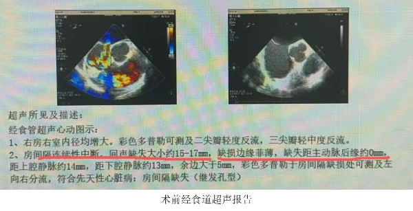 一次介入破解“巨大房缺+金属过敏”双重难题！金坛一院首例可降解封堵术为患者无痕“补”心 