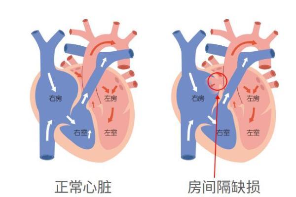 一次介入破解“巨大房缺+金属过敏”双重难题！金坛一院首例可降解封堵术为患者无痕“补”心 