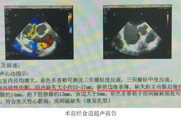 一次介入破解“巨大房缺+金属过敏”双重难题！金坛一院首例可降解封堵术为患者无痕“补”心 