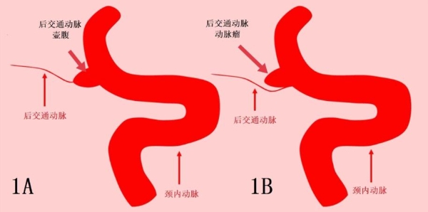 从量产交付走向实战考场：国产光子计数CT能否经受临床大考？ 