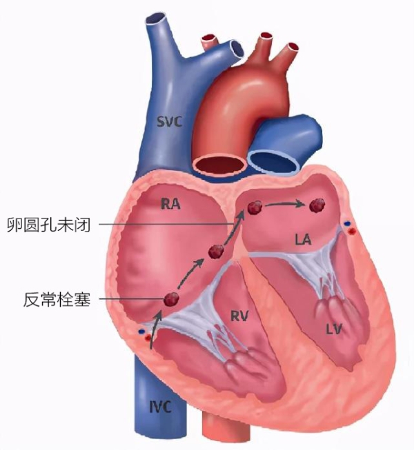 年轻难治性偏头痛患者：卵圆孔未闭筛查与可降解封堵器的远期获益 