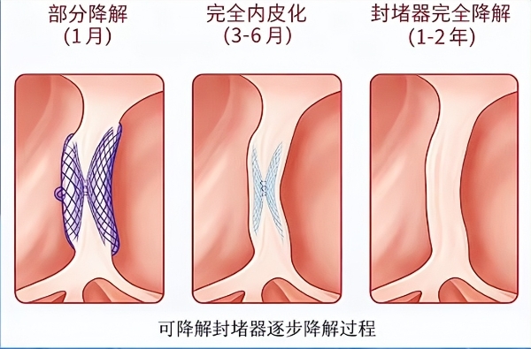 反复莫名偏头痛？南医大二附院MemoSorb可降解新技术除心头隐患 