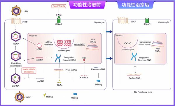慢乙肝的功能性治愈