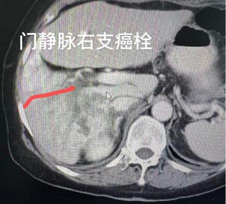 世界首次丨单针维纳刀消融门静脉癌栓——牛立志院长突破肝癌血管侵犯消融瓶颈 