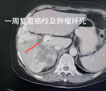 世界首次丨单针维纳刀消融门静脉癌栓——牛立志院长突破肝癌血管侵犯消融瓶颈 