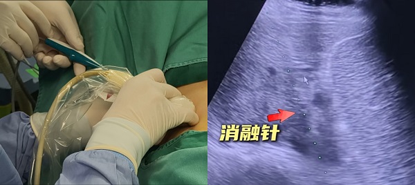 世界首次丨单针维纳刀消融门静脉癌栓——牛立志院长突破肝癌血管侵犯消融瓶颈 