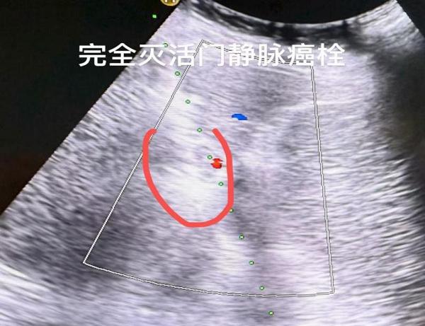 世界首次丨单针维纳刀消融门静脉癌栓——牛立志院长突破肝癌血管侵犯消融瓶颈 
