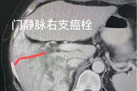 世界首次丨单针维纳刀消融门静脉癌栓——牛立志院长突破肝癌血管侵犯消融瓶颈 